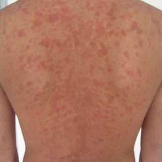 Avoiding Heat Rash with Merino Wool